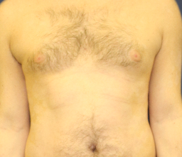 Patient after, week 48, chest image