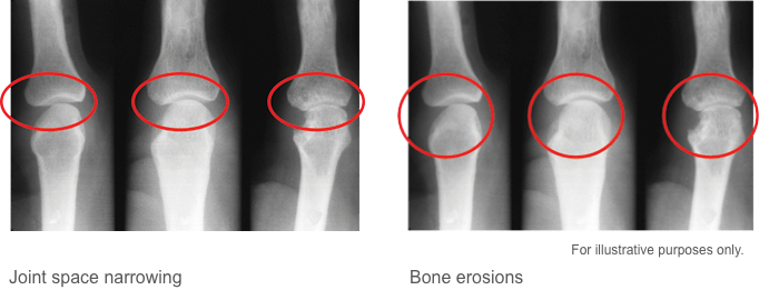 joint space and bone erosians image