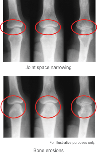 joint space and bone erosians image