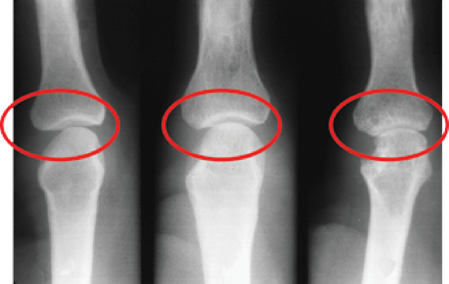 X-ray of bones
